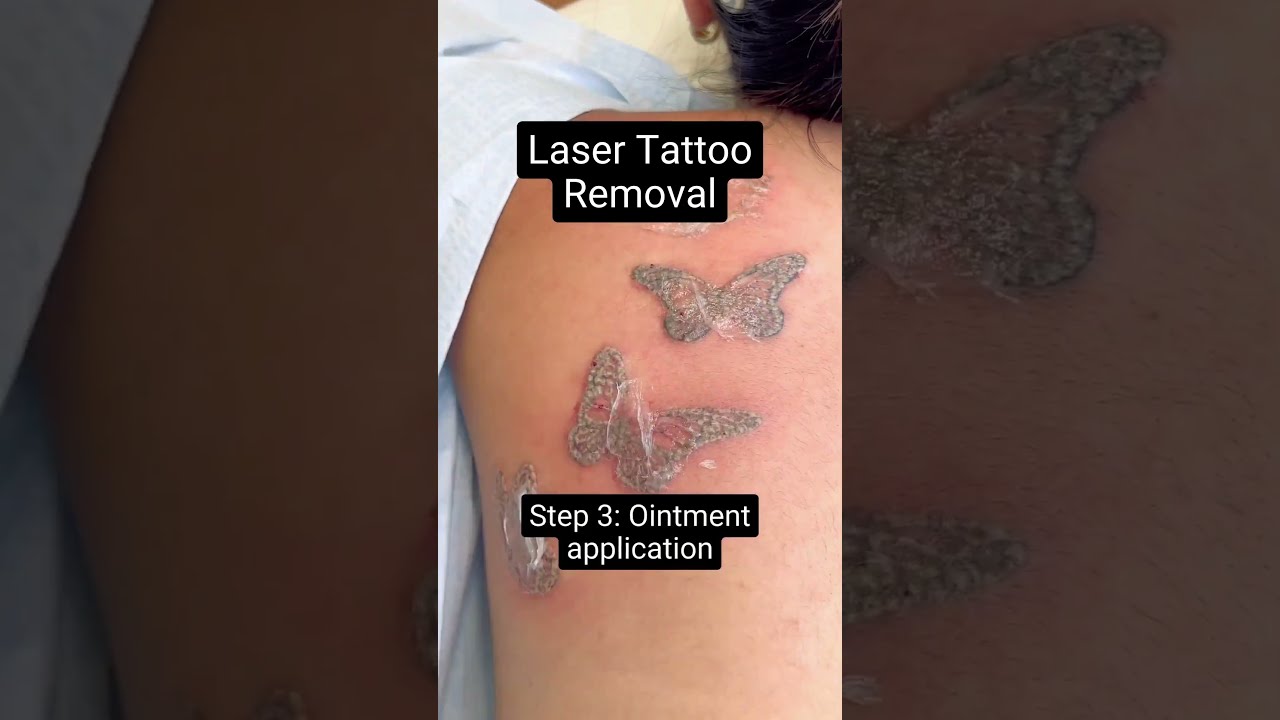 Skin Physiology and why it Matters with Tattoo Application and Tattoo  Removal - New Look Laser College